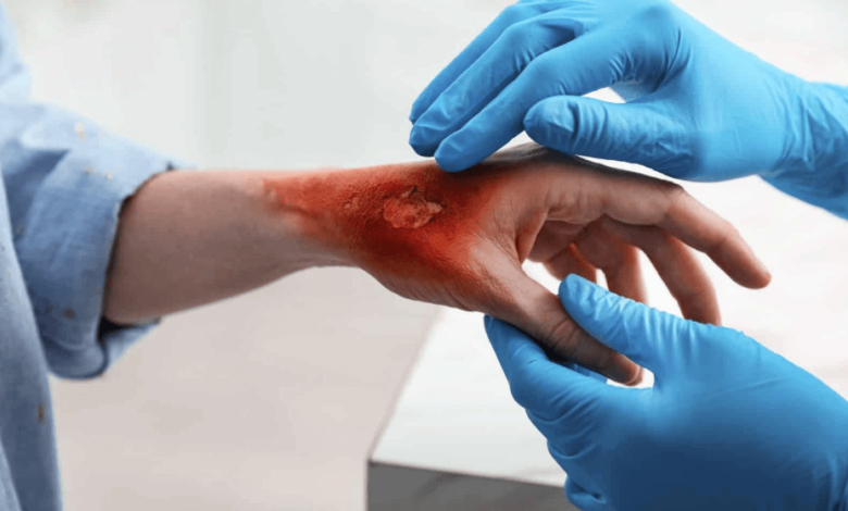 Key Factors Affecting Burn Injury Claims in Phoenix